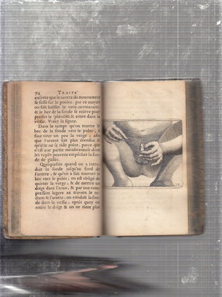 Traite de la Lithotomie ou De Extraction De La Pierre Hors La Vessie, Avec les Figures (A Treatise of Lithotomy: or, of the extraction of the stone out of the bladder)